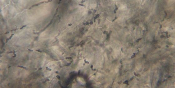 Рис. 4. Мицелий, артроспоры CANV в пораженных тканях (микроскопия в КОН)